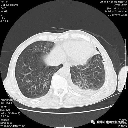 手术引起乳糜胸,有没有做了肺结节手术后是误诊的