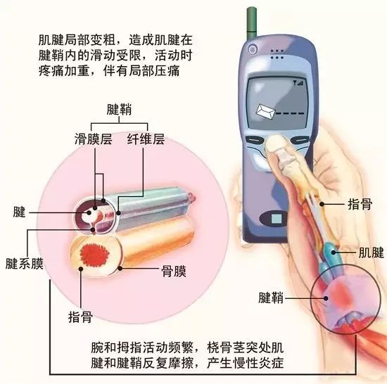玩手机腱鞘炎中指,玩手机手腱鞘炎