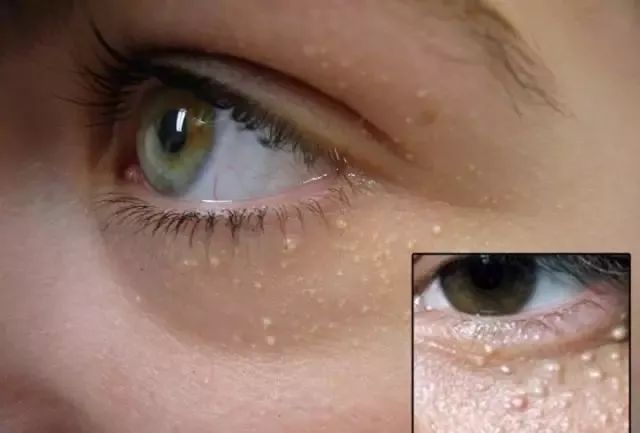 小孩眼睛周围的脂肪粒怎么去除,眼睛周围的脂肪粒怎么快速消除