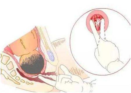 宫颈不成熟放水囊催生成功率高吗,怀孕41周还没发动要不要住院催产