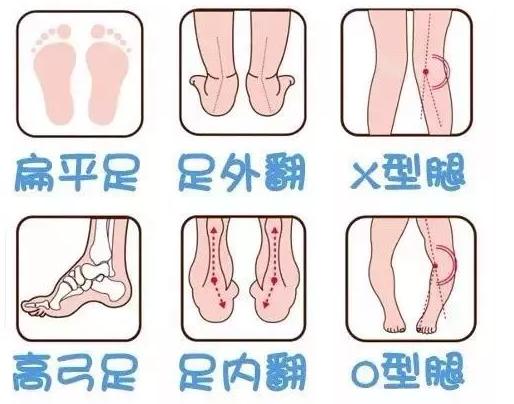 这8种凉鞋被列入黑名单，易致足内翻、X型腿，可别再给娃穿了