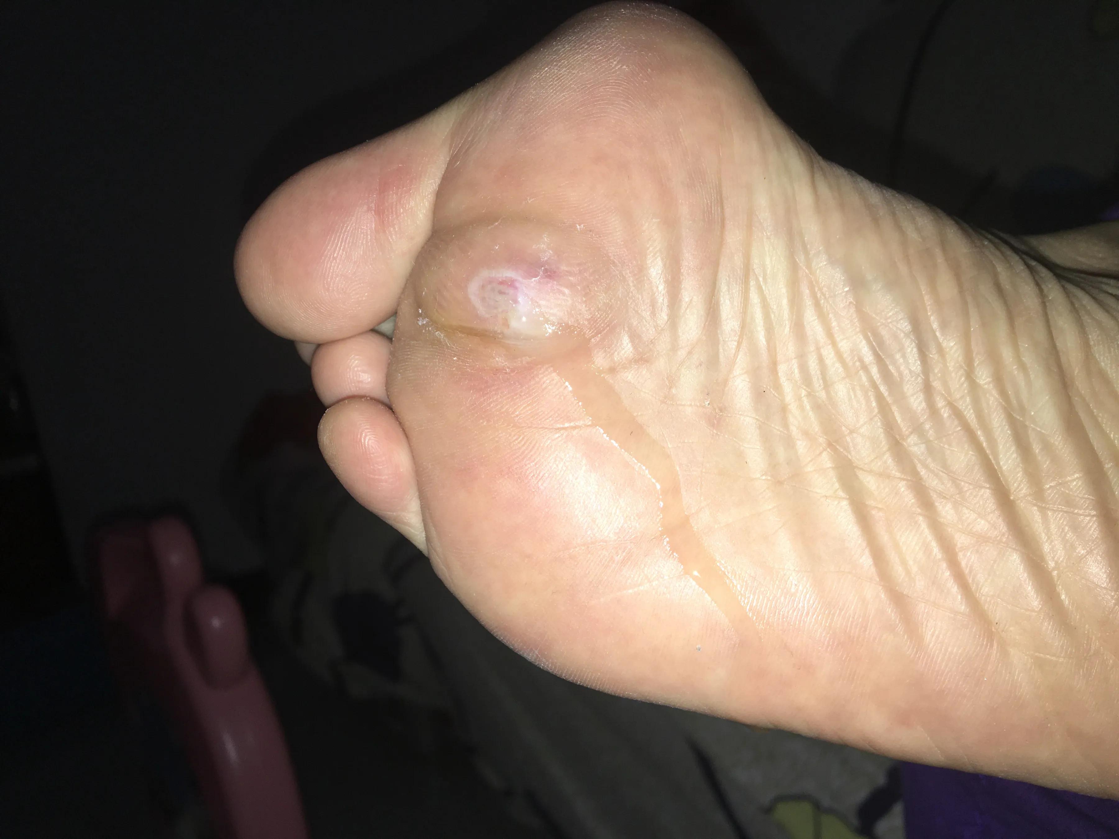 腰椎全麻手术的亲身经历,腰麻手术过程中是不是很可怕