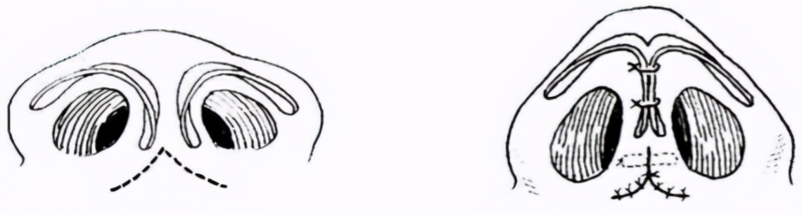 鼻骨过宽怎么改善,鼻骨过宽怎么化妆