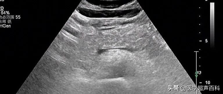 自身免疫性胰腺炎的超声诊断要点,急性轻胰腺炎消化系统变化