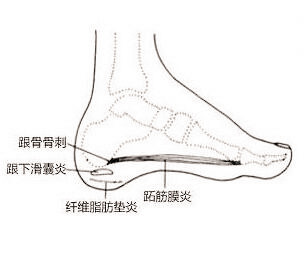 脚后跟疼怎么治一走路就疼,脚后跟痛一招解决小窍门