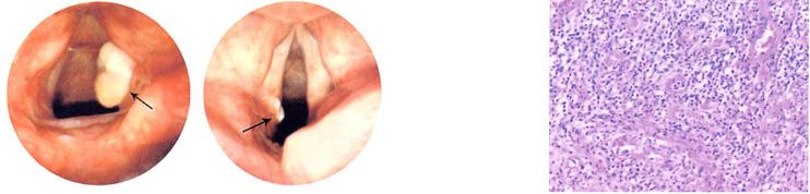 喉接触性肉芽肿的病因,喉接触性肉芽肿中医辨证