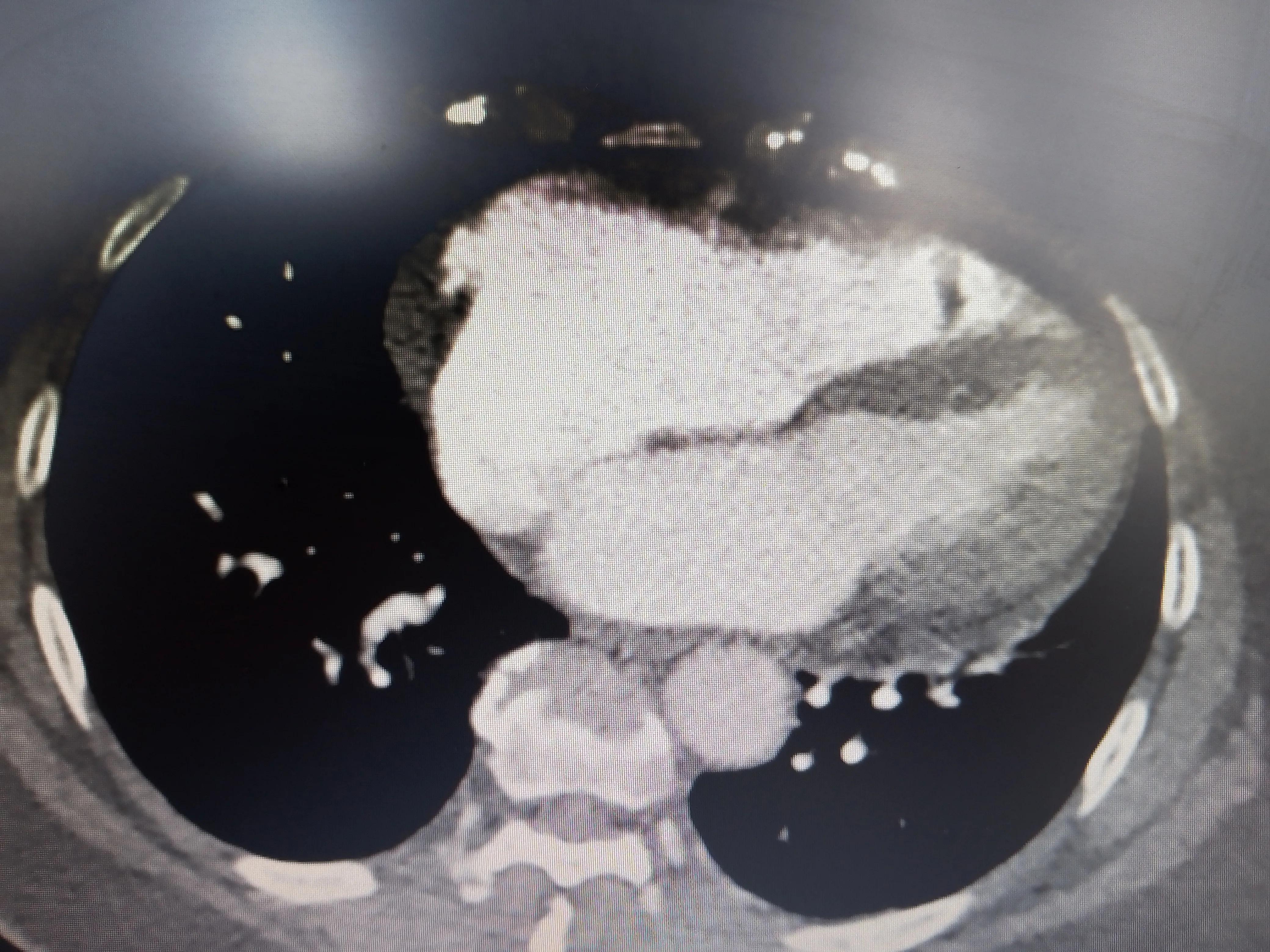 血汗管病人吃伟哥,血汗管病人可以用伟哥吗