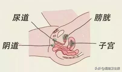 福建女子度完蜜月后出现尿频尿急，竟是患上这病！国庆刚结婚的要关注了！