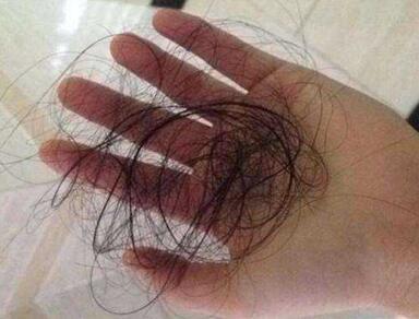 头发出现大量掉发怎么办,头发为什么掉发很严重