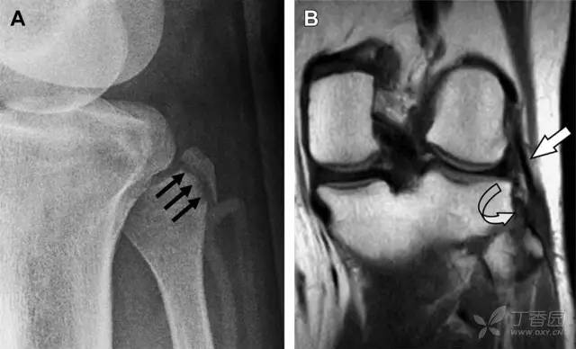 常见的八种骨折,容易漏诊的肩关节骨折