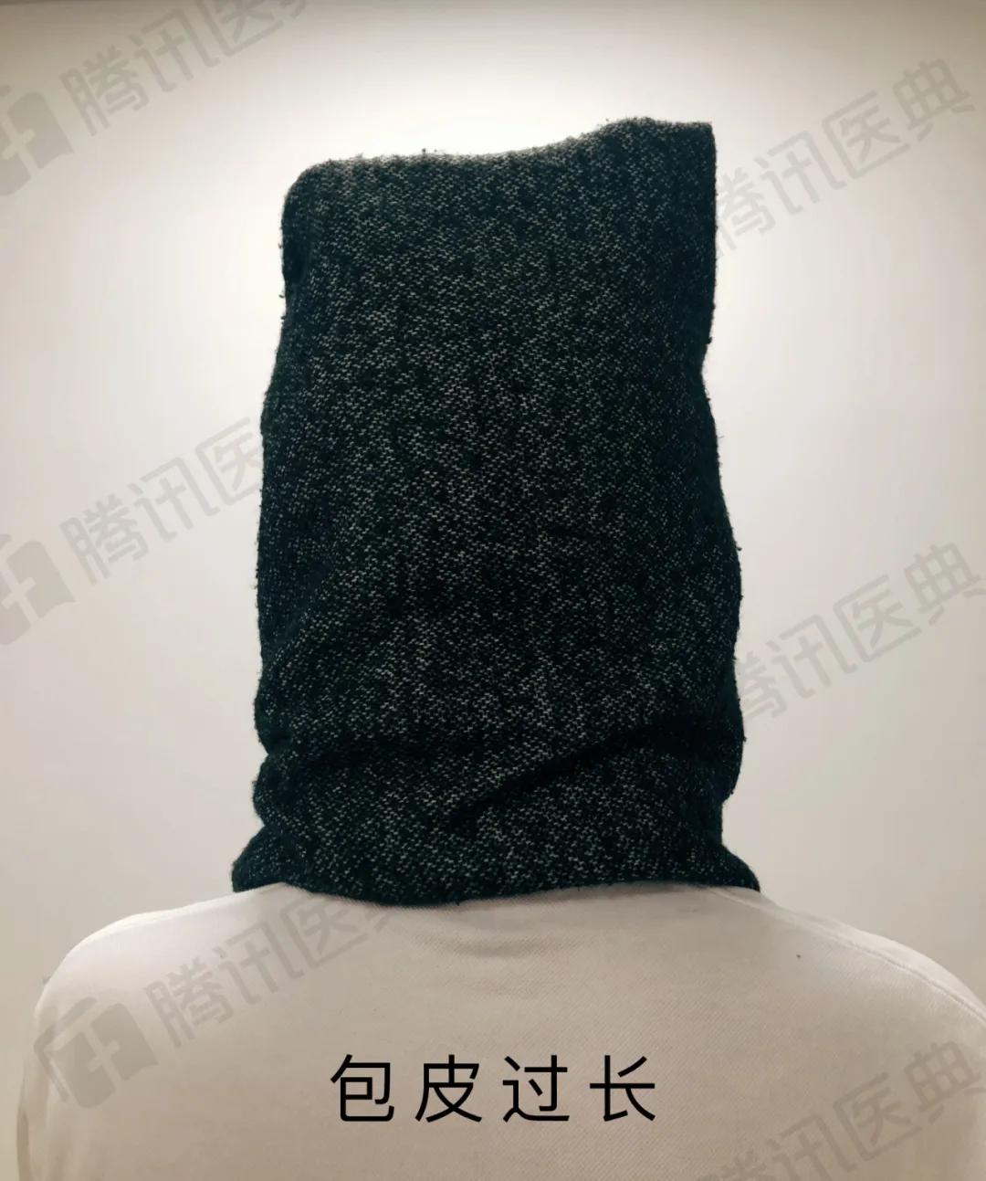 割包皮能治疗好疱疹吗,割包皮属于大手术么