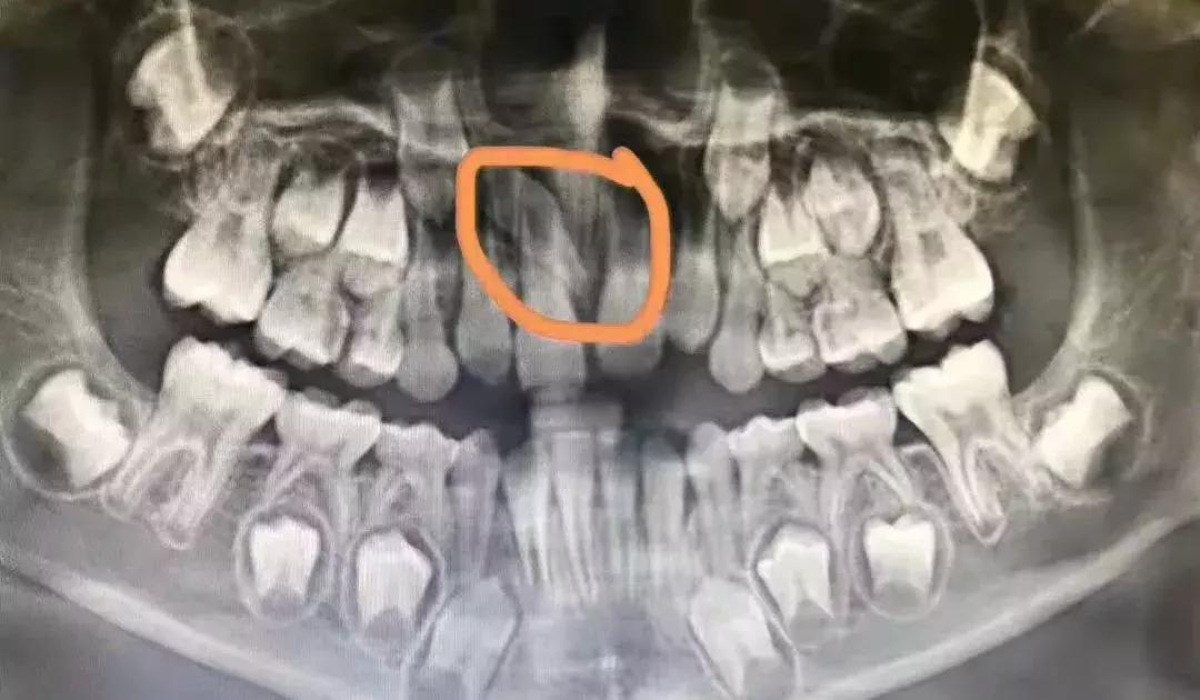 孩子喜欢打闹招惹别人怎么办,儿童埋伏多生牙