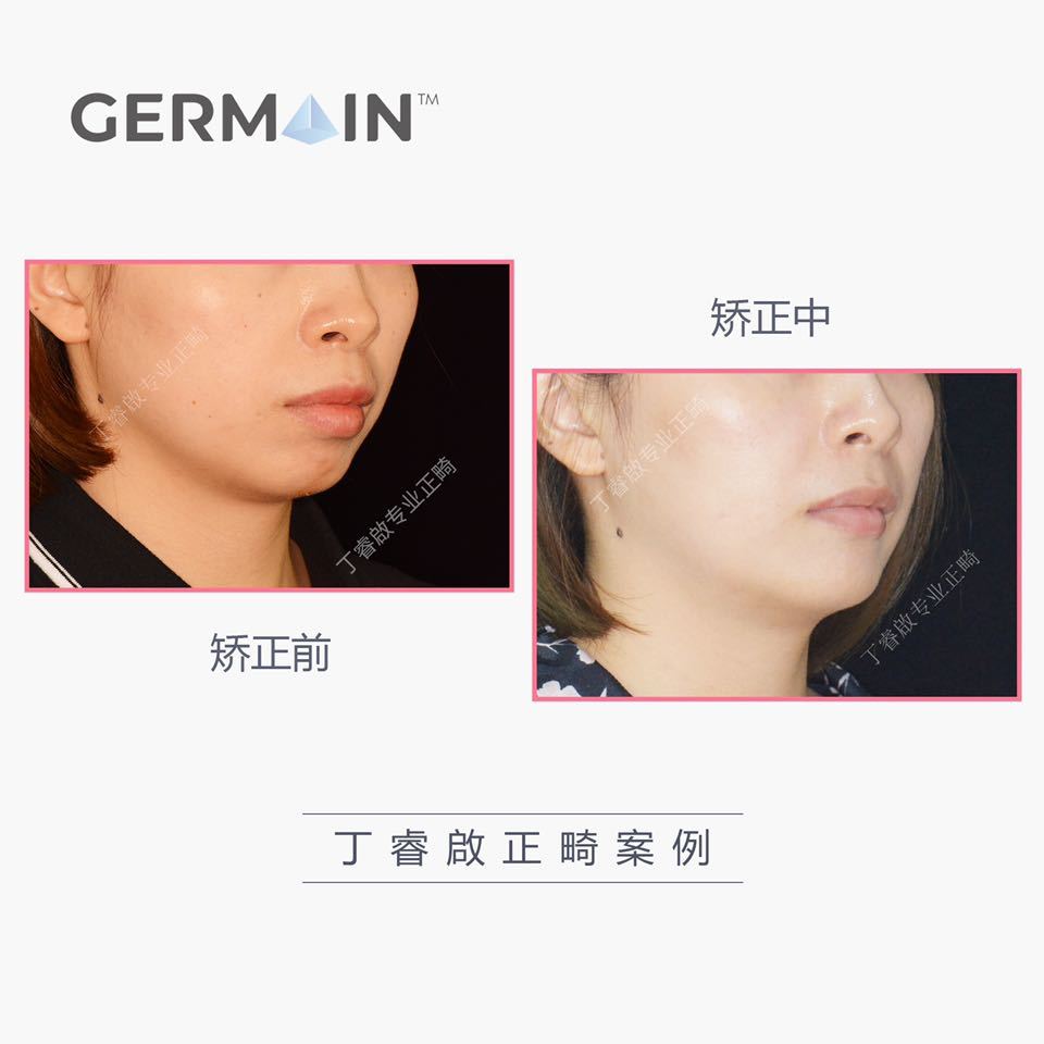 郑州牙齿矫正丁睿啟｜下巴后缩病例合集