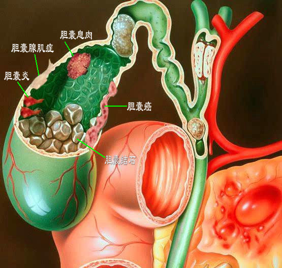 胆囊结石切除后影响寿命,胆囊切除对人寿命影响吗