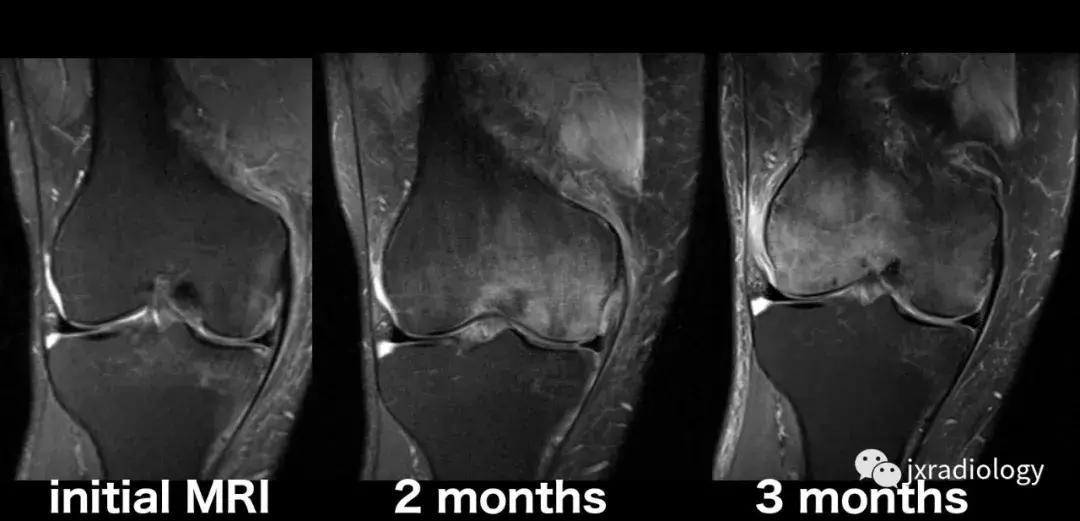 磁共振骶髂关节骨髓水肿是强直吗,磁共振显示骨髓水肿什么意思