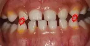 小朋友牙齿地包天矫正方法,牙齿地包天多大矫正最合适