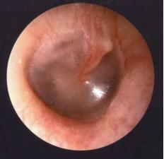 小孩说耳朵疼是中耳炎吗,儿童中耳炎引起的耳痛怎么解决