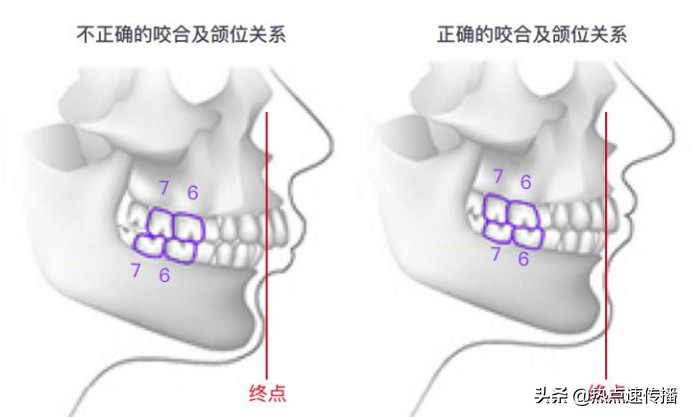 导致下巴歪的原因有哪些,下巴后缩严重的案例