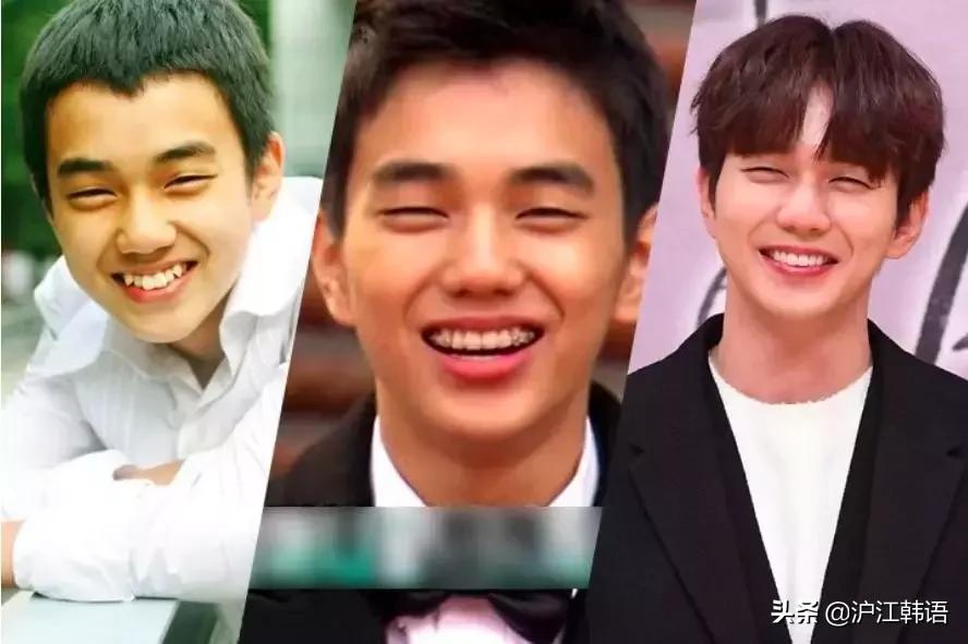 女明星矫正牙齿前后对比,明星牙齿矫正前后对比图