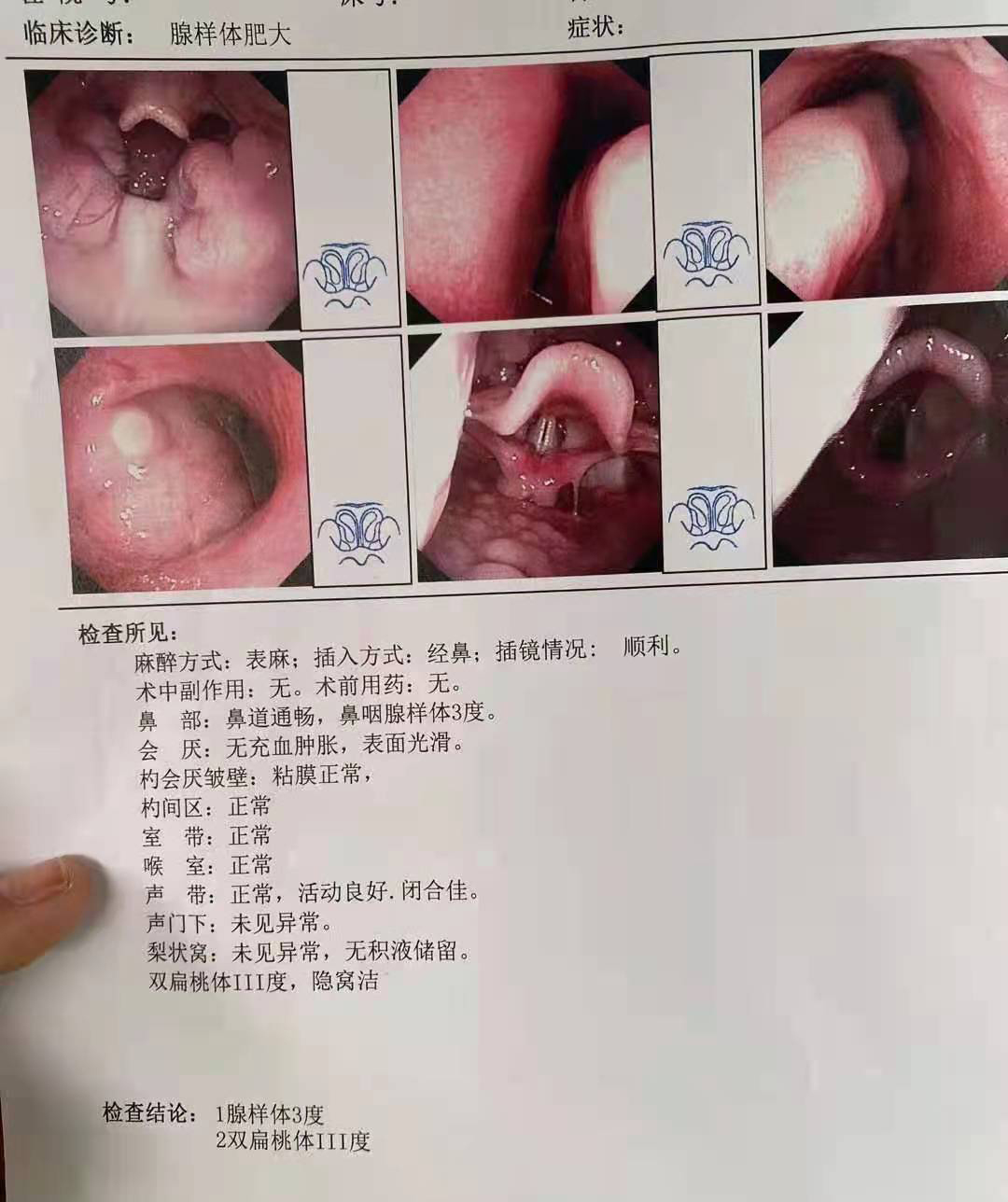 省中医看腺样体肥大哪个医生最好,儿童腺样体重度肥大的危害