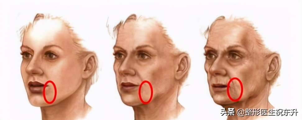 嘴角两旁的嘟嘟肉怎么去除,如何改善嘴角嘟嘟肉