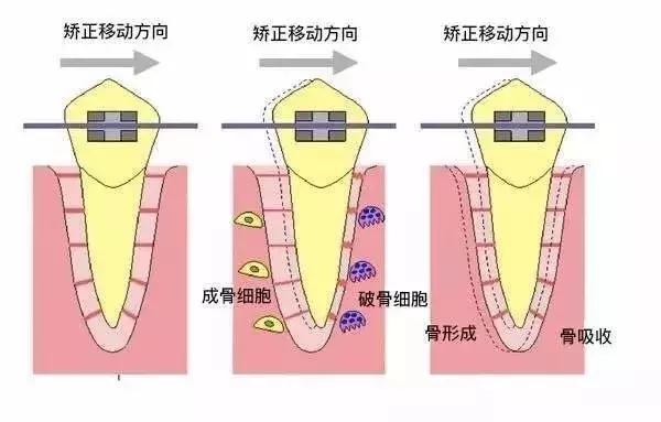 戴一个牙套牙会黑吗,戴个牙套有什么用处