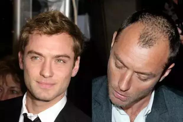 发际线高头发稀疏掉头发怎么拯救,发际线后移的头发还能长出来么