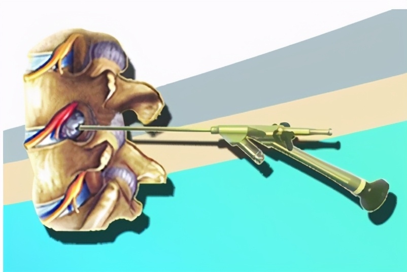 腰椎管狭窄微创手术后戴腰带多久,腰椎管狭窄微创手术后关注事项