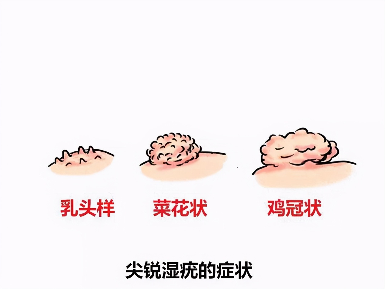 感染HPV后身体有哪些症状,肛周hpv感染症状和痔疮的区别
