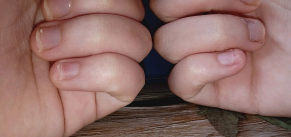 小朋友咬指甲抠指甲的危害,孩子咬手指甲抠指甲是什么原因