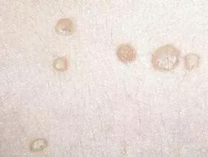 不痒不过敏的疹子，是HPV感染？医生：3分钟科普扁平疣与宫颈癌