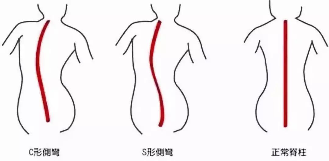 怎么拯救弯腰驼背的孩子,小孩脊柱不正怎么矫正最有效