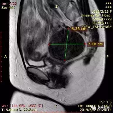 超声介入消融治疗卵巢囊肿,微无创治疗子宫肌瘤过程