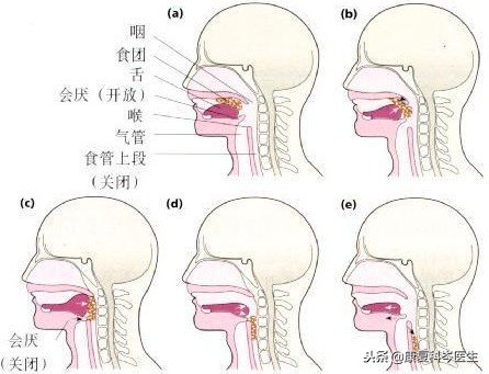 中风后吞咽障碍怎么康复,中风后吞咽困难中医的治疗方法