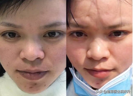 打水光针真实感受,打水光针好的评价