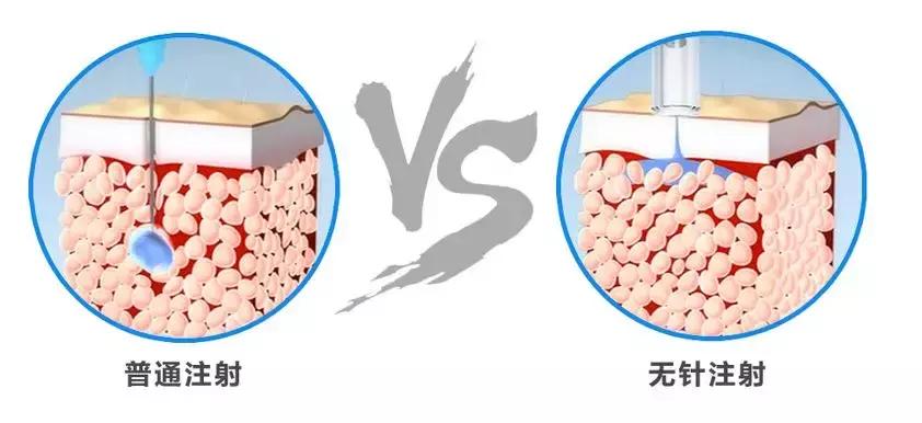无痛胰岛素无针注射器,糖尿病无痛无针注射器靠谱吗