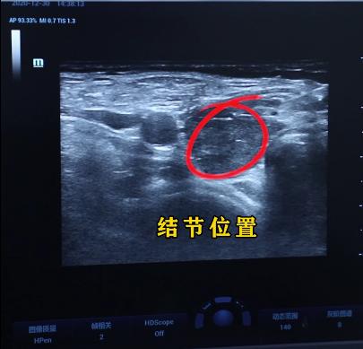 甲状腺结节07x06实性结节严重吗,甲状腺结节1.2厘米囊实性结节