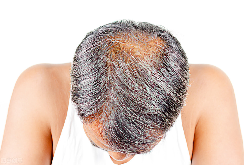 鬼剃头脱发治疗最快的方法,斑秃俗称鬼剃头有什么办法根治