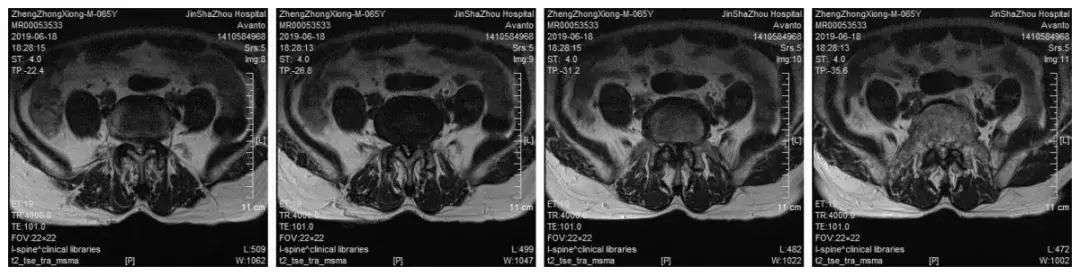 椎间盘突出和椎管狭窄症状的区别,腰椎管狭窄症的症状