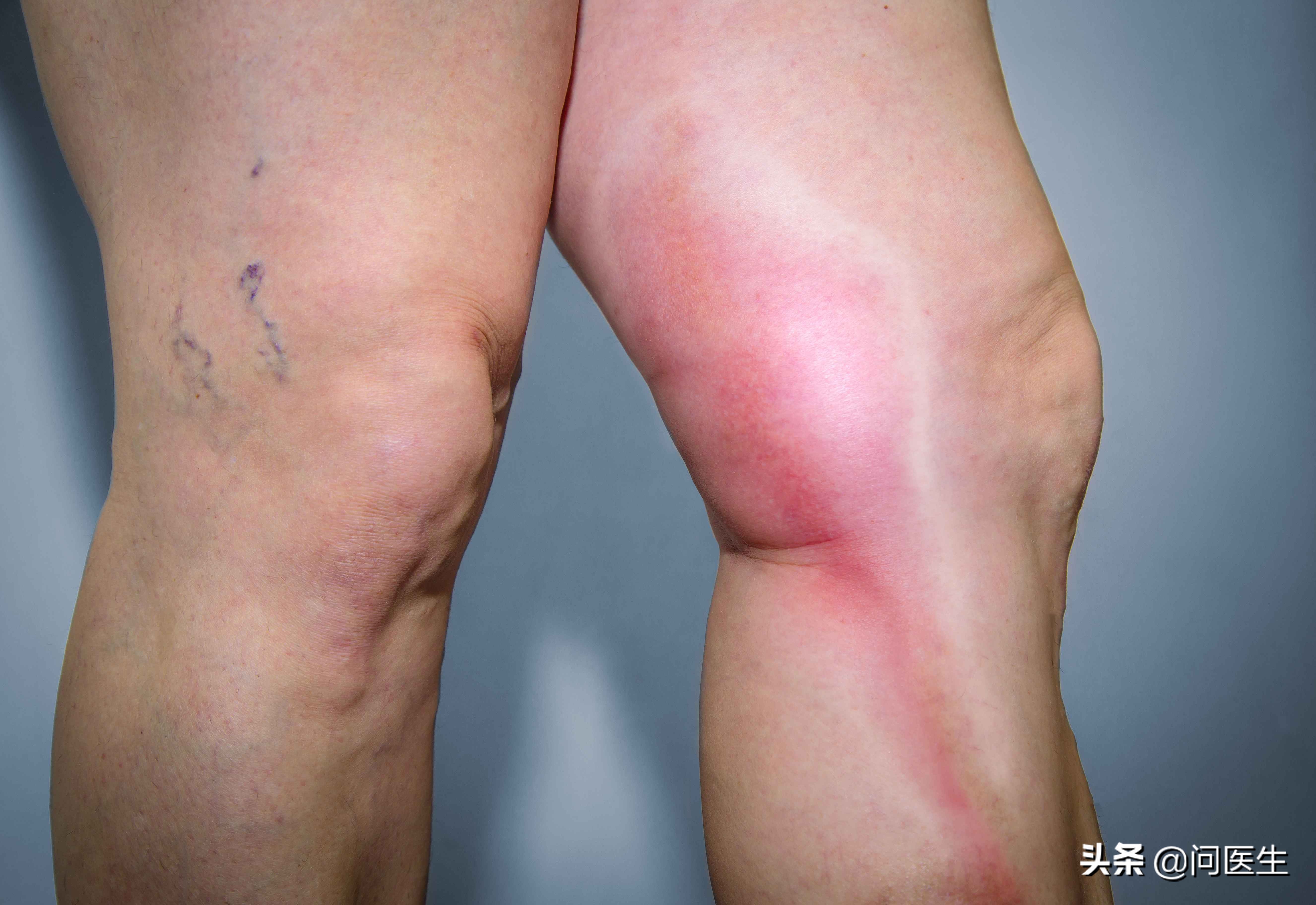 尿酸高脚部有什么反应,尿酸高低肢水肿