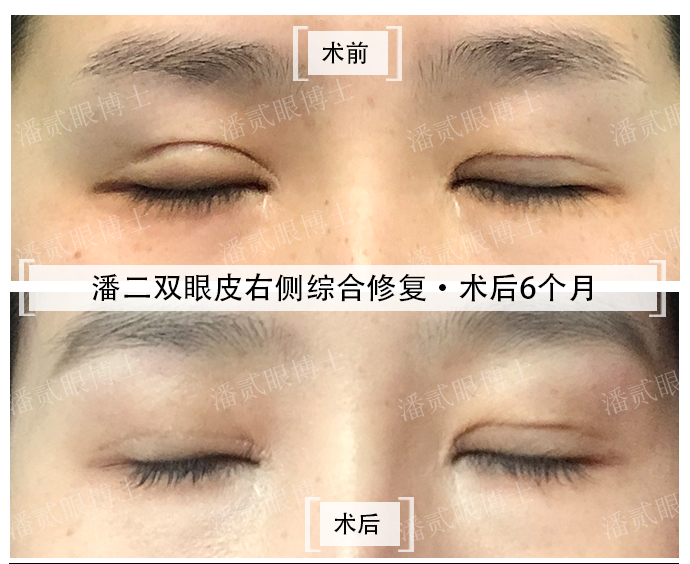 双眼皮修复具体要问什么,双眼皮修复过程中关注事项