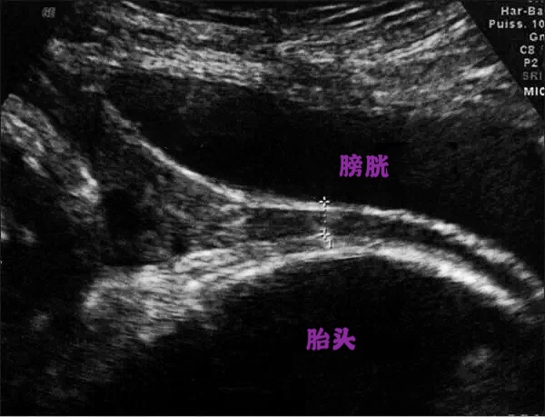超声检查膀胱壁毛糙可以吃什么药,做膀胱彩超检查用憋尿吗