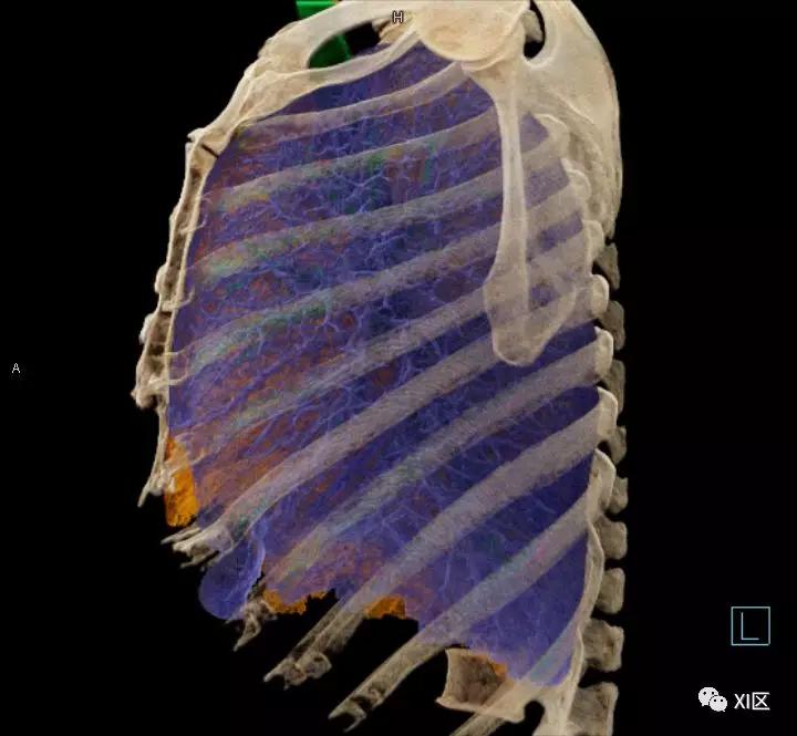 如此详细的肺部影像解剖，有点儿酷