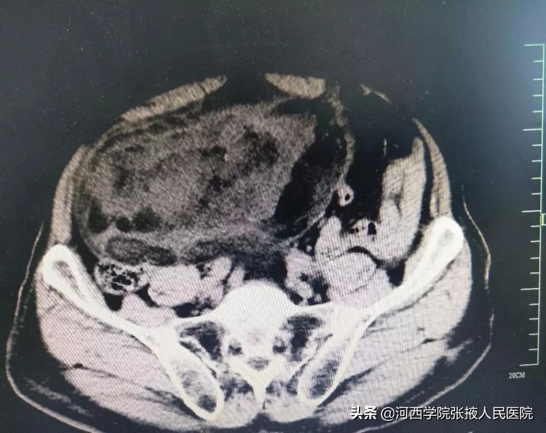 80多岁腹膜后肿瘤,高龄腹腔良性肿瘤手术风险