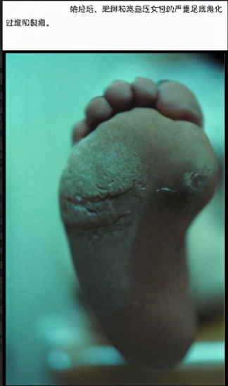 老年人脚底皮肤皲裂症原因是什么,更年期脚后跟皲裂是怎么回事