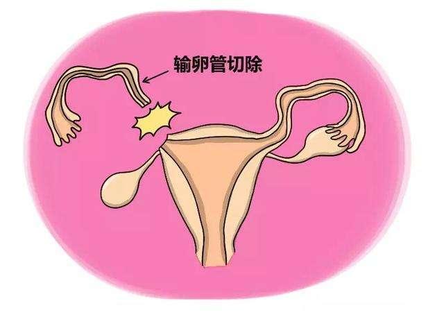 为什么感觉宫外孕那么常见，切了输卵管女性怎么办？