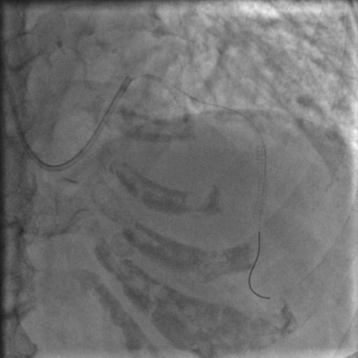 85岁老人心脏堵塞,77岁老人冠脉狭窄放支架还是搭桥