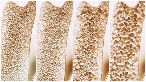 血钙含量和骨质疏松有关吗？