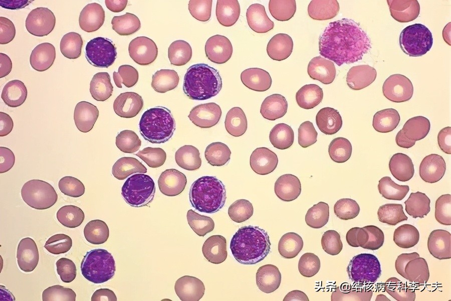 肺结核白细胞低怎么食补,肺结核白细胞减少是什么原因