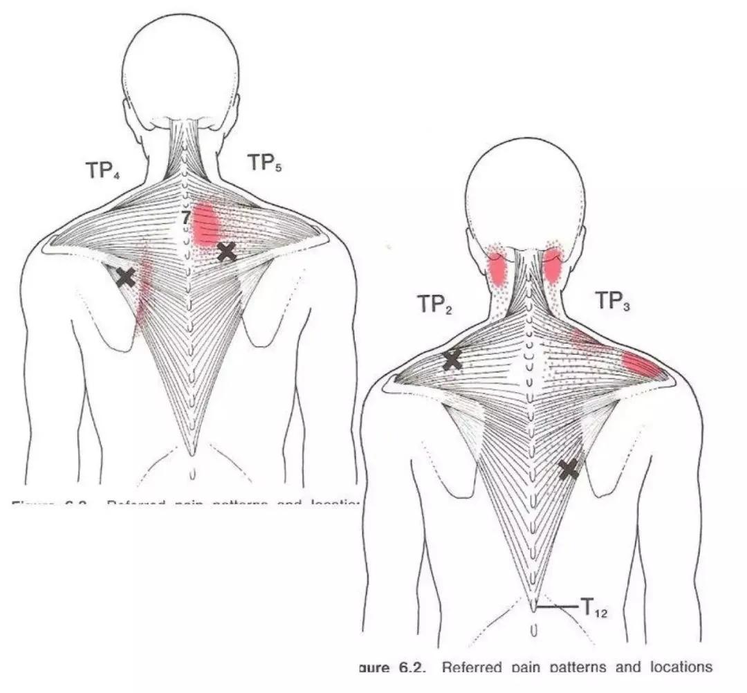落枕了后颈痛一招搞定,筋膜枪治疗落枕的最快方法